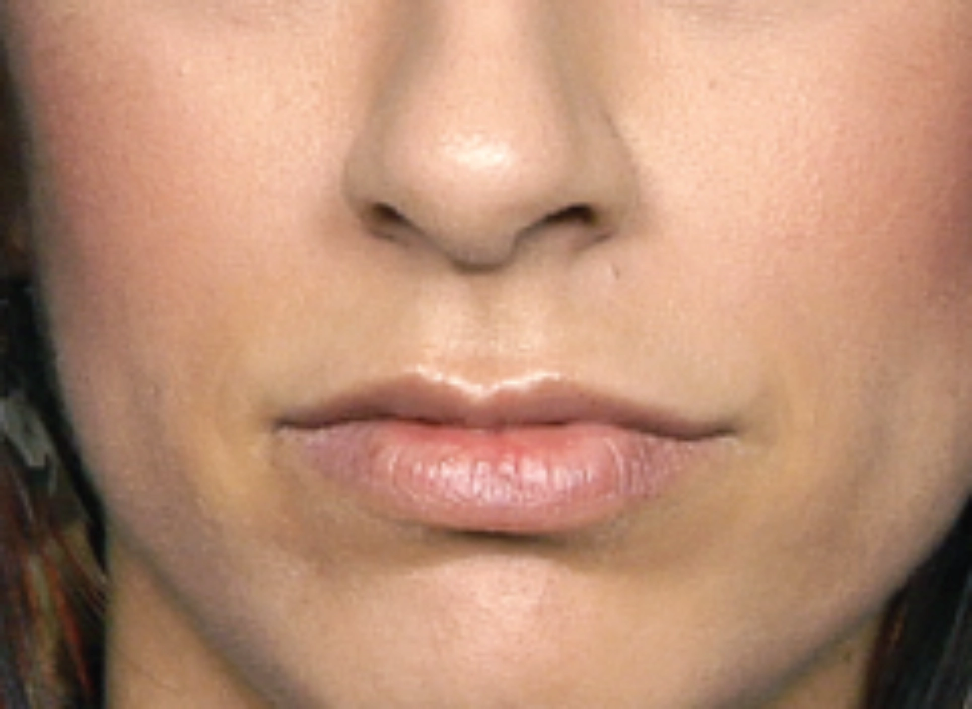 restylane
