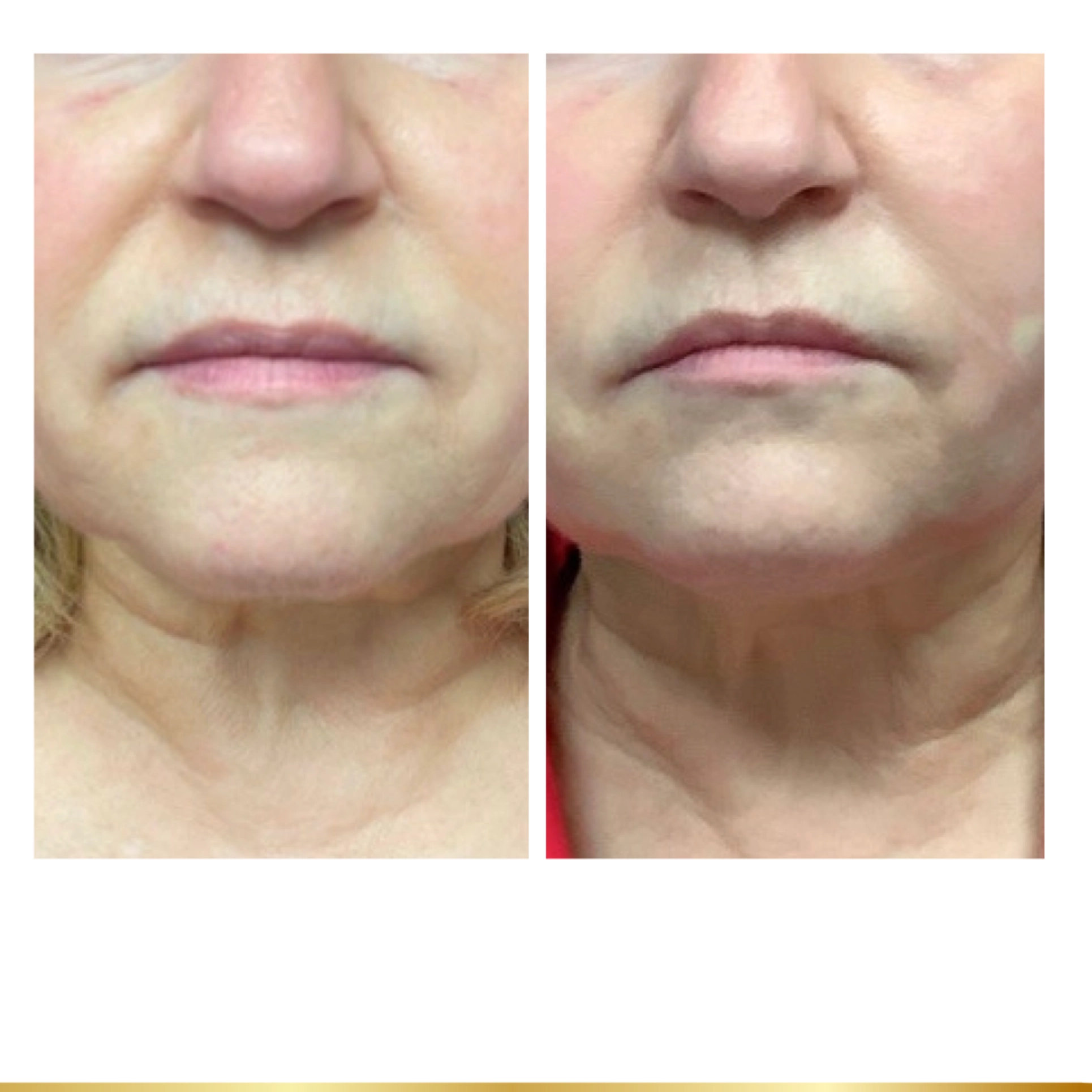 Before and after comparison showing PDO Threadlift facial lifting results at Park City Medesthetix