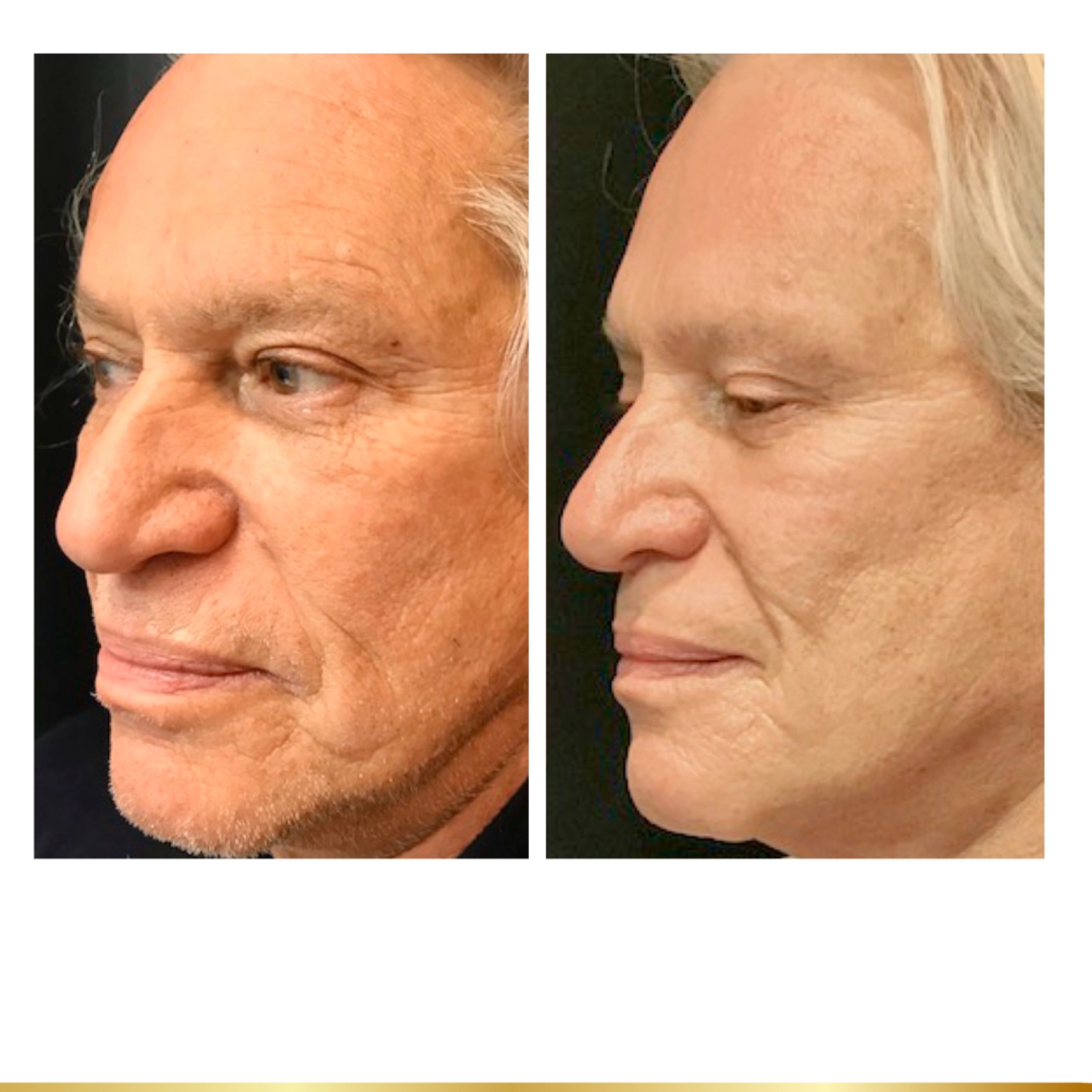 Side profile before and after showing facial lifting results from PDO Threadlift at Park City Medesthetix