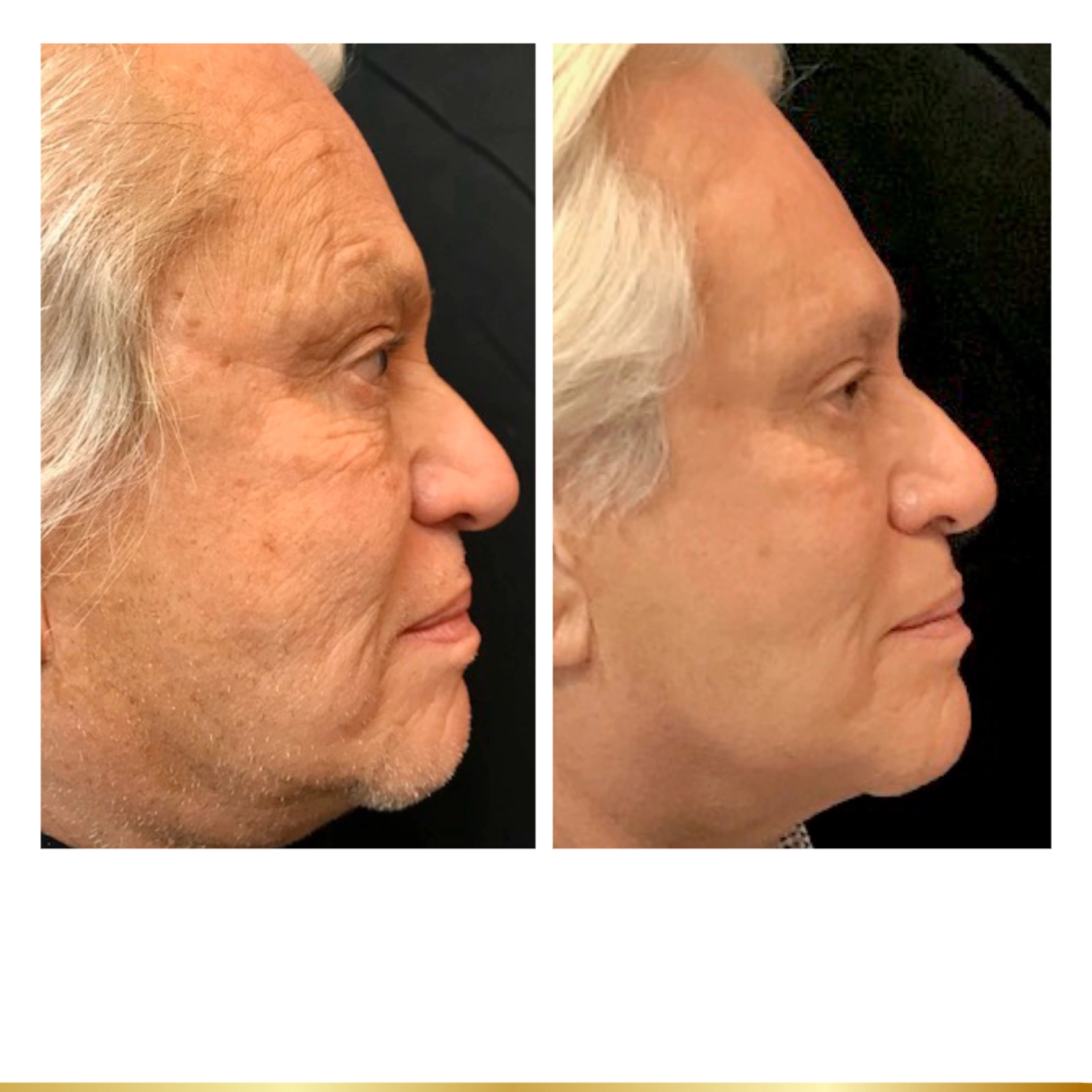 Full face before and after PDO Threadlift demonstrating skin tightening and lifting results