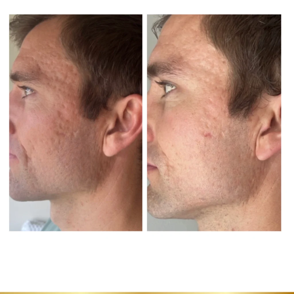 Before and after Genius RF Microneedling on male patient showing visibly reduced acne scarring and improved skin texture on cheek and jaw at Park City Medesthetix